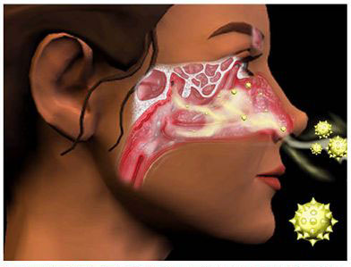 Az allergia folyamatát mutató ábra az orrban.