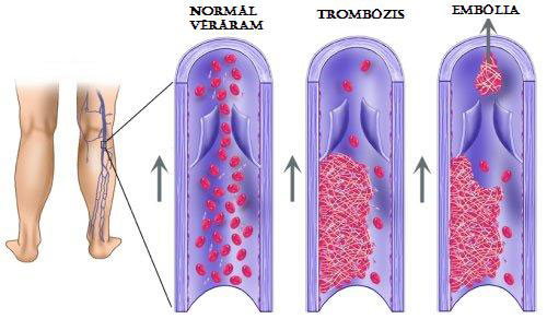 A vénás tromboembólia kiváltó okai és tünetei